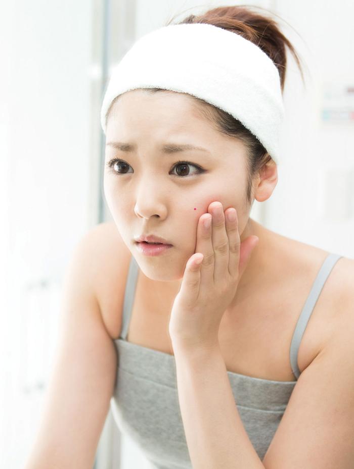 Hormonal imbalance is the main cause of acne
