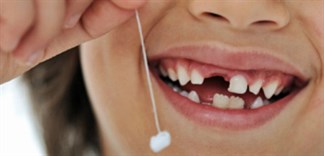 Cách nhổ răng sữa cho bé tại nhà an toàn không đau