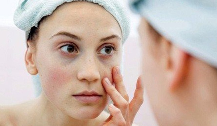 Hướng Dẫn 3 Cách Trị Thâm Quầng Mắt Bằng Muối Tại Nhà Hiệu Quả