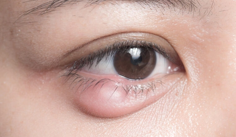 10 mẹo chữa lẹo mắt đơn giản tại nhà, hiệu quả nhanh chóng