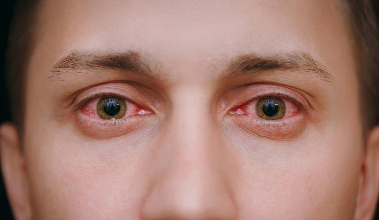 Đau mắt đỏ cần kiêng gì, ăn gì để nhanh khỏi bệnh?