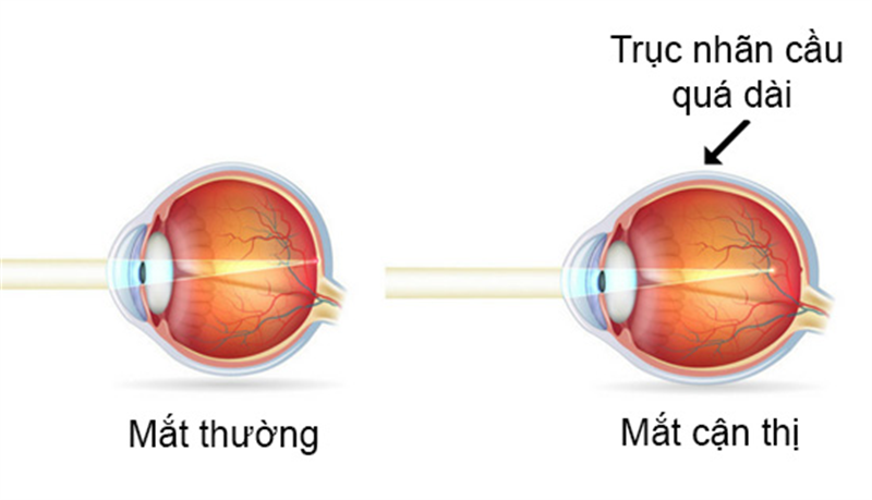 Nguyên nhân dẫn đến cận thị trục nhãn cầu của mắt quá dài