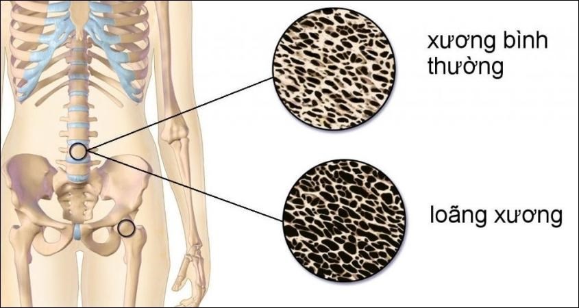 Giảm nguy cơ loãng xương