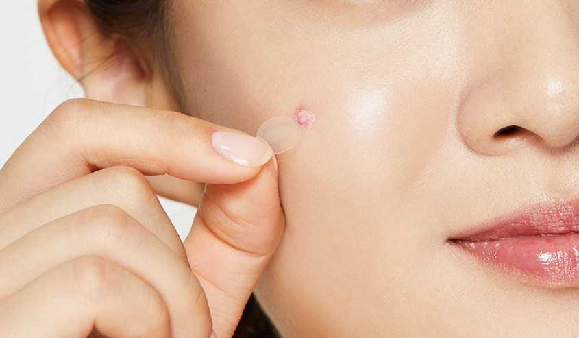 Sử dụng miếng dán mụn liên tục cho đến khi nhân mụn trồi lên
