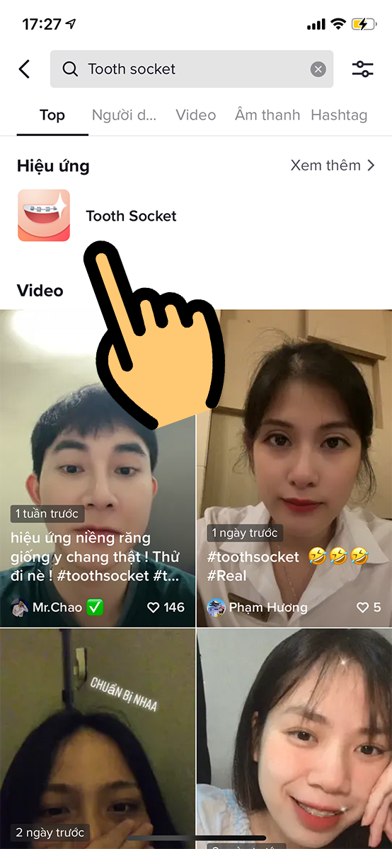 Hiệu ứng niềng răng&nbsp;Tooth socket