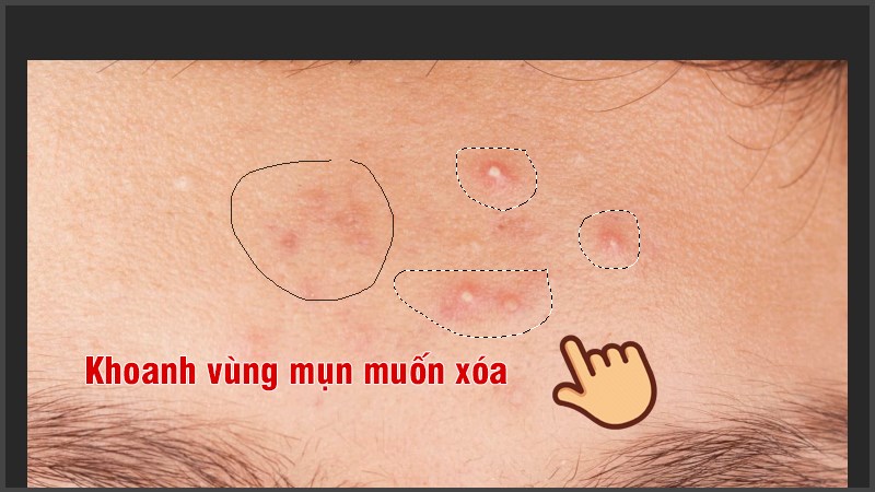 Khoanh vùng mụn mà bạn muốn loại bỏ