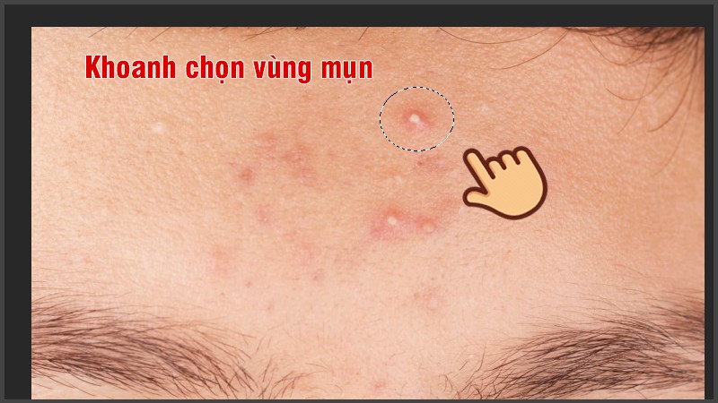 Khoanh vùng mụn muốn xóa