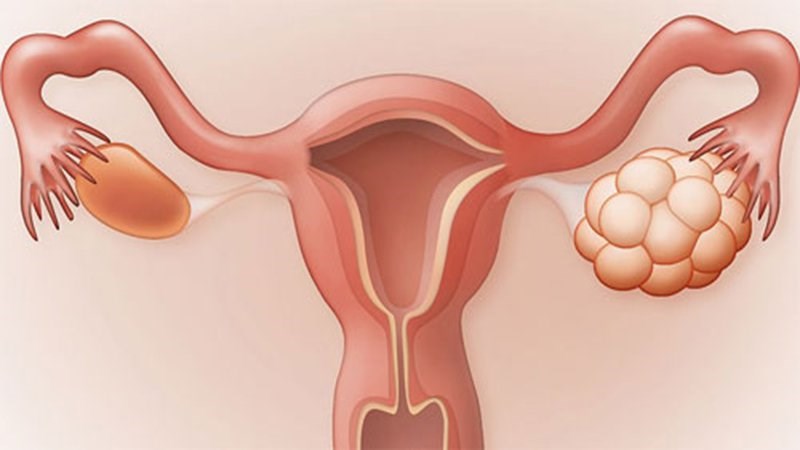 Người bị hội chứng buồng trứng đa nang có thể có nhiều kỳ kinh trong một tháng