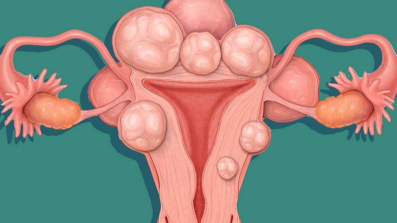 Cả polyp và u xơ tử cung đều có thể gây ra các vấn đề về chu kỳ kinh nguyệt