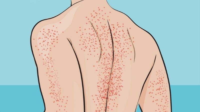 Xuất huyết giảm tiểu cầu nguyên phát là một bệnh tự miễn dịch 