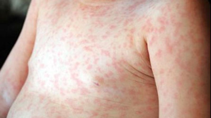 Việc sử dụng aspirin ở trẻ em có thể gây ra hội chứng Reye