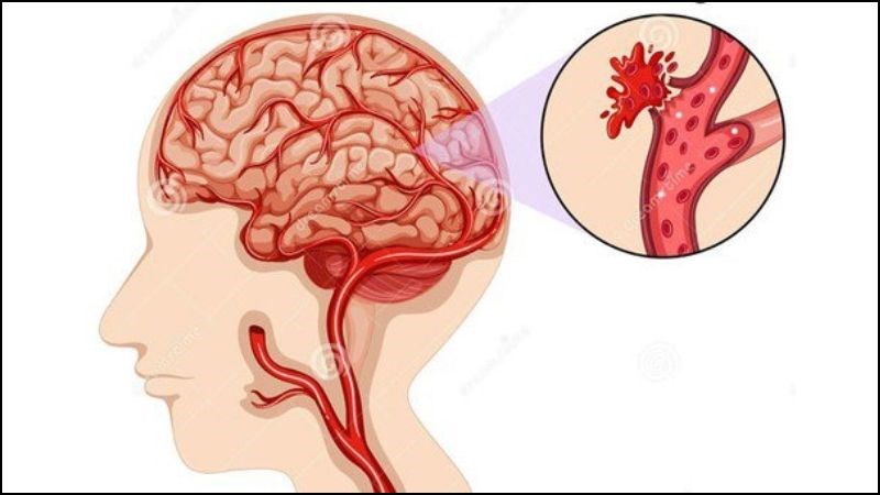 Aspirin có thể gây đột quỵ do xuất huyết não