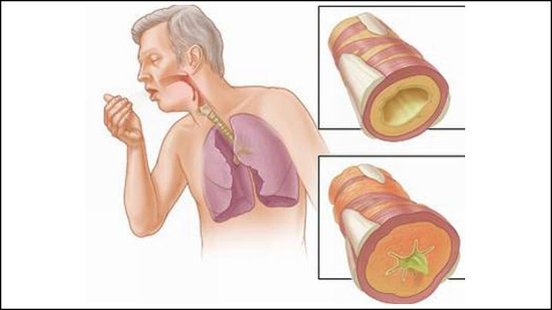 Aspirin không nên dùng cho người có tiền sử bệnh hen