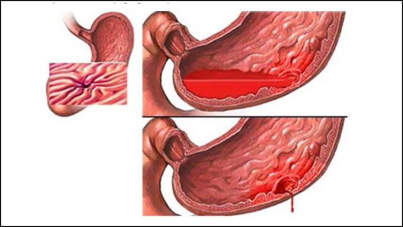 Sử dụng aspirin hàng ngày có thể gây viêm loét dạ dày và xuất huyết tiêu hóa nặng