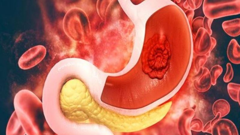 Thuốc chống trầm cảm làm tăng nguy cơ xuất huyết tiêu hoá.