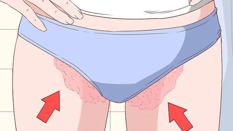 Nấm bẹn là một loại bệnh nấm da do nấm Dermatophyte tác động lên vùng bẹn