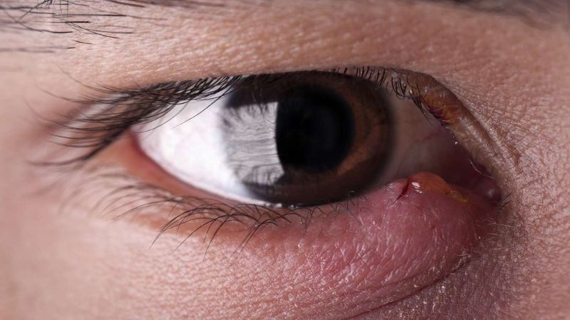 Sưng mắt là tình trạng mà mí mắt trên hay dưới bị sưng lên Sưng mắt là tình trạng mà mí mắt trên hay dưới bị sưng lên