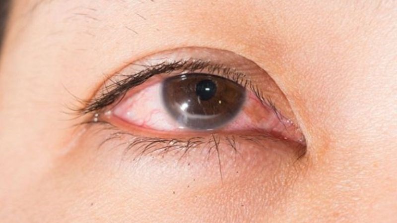 Viêm bờ mi là tình trạng viêm nhiễm do vi khuẩn gây sưng mí mắt Viêm bờ mi là tình trạng viêm nhiễm do vi khuẩn gây sưng mí mắt