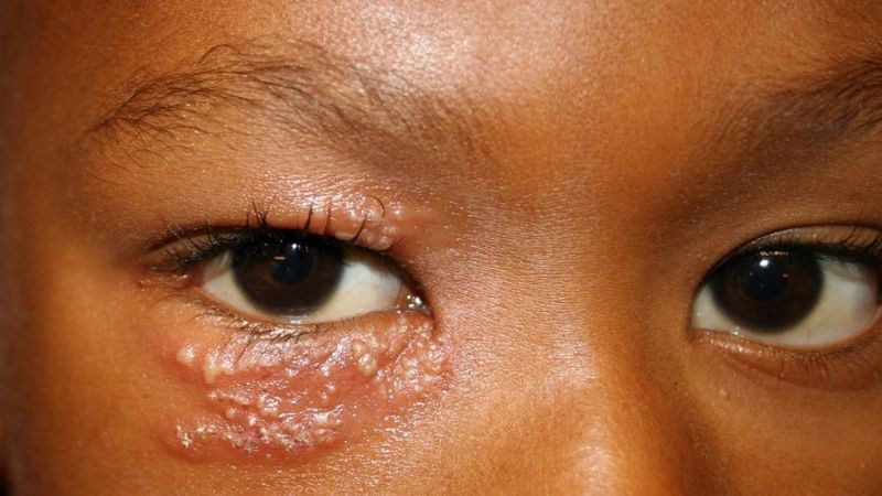Mụn rộp ở mắt thường gặp ở trẻ em Mụn rộp ở mắt thường gặp ở trẻ em