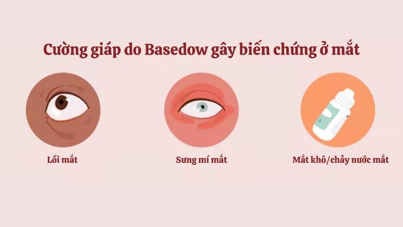 Người mắc bệnh Grave (Basedow) thường bị sưng mí mắt Người mắc bệnh Grave (Basedow) thường bị sưng mí mắt