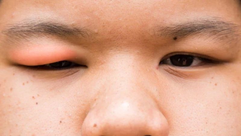 Viêm mô tế bào hốc mắt là một loại nhiễm trùng sâu trong mô mí mắt Viêm mô tế bào hốc mắt là một loại nhiễm trùng sâu trong mô mí mắt