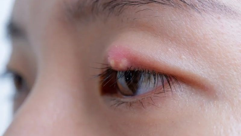 Lẹo mắt xảy ra do viêm và nhiễm trùng là nguyên nhân gây sưng mí mắt Lẹo mắt xảy ra do viêm và nhiễm trùng là nguyên nhân gây sưng mí mắt