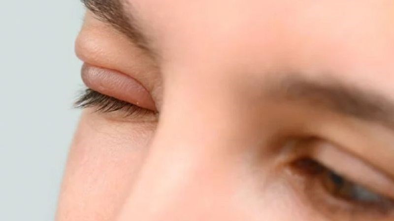 Viêm tế bào ổ mắt là loại nhiễm trùng xâm nhập sâu vào các mô trong mí mắt Viêm tế bào ổ mắt là loại nhiễm trùng xâm nhập sâu vào các mô trong mí mắt