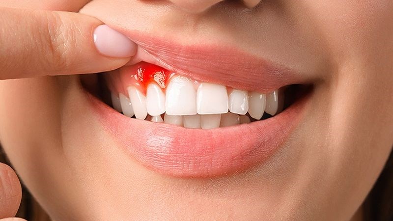 Các tình trạng chảy máu có thể xảy ra nếu dùng dầu cá quá mức