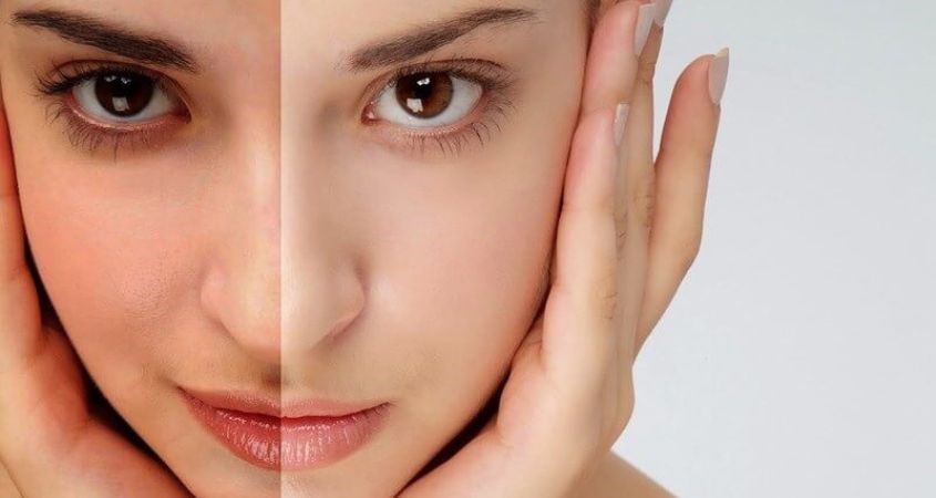 Hydroquinone là một chất có khả năng làm sáng da