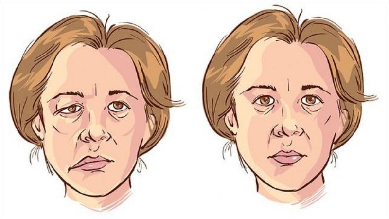Bệnh nhược cơ có thể gây sụp mí mắt