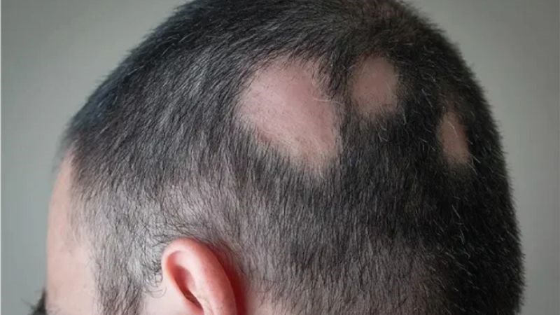 Xạ trị có thể dẫn đến rụng tóc thành mảng