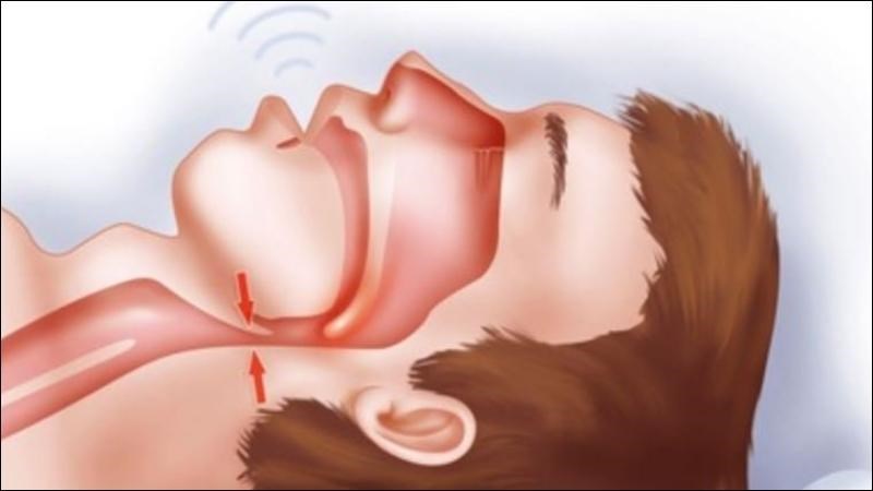 Hội chứng ngưng thở do tắc nghẽn đường hô hấp gây mệt mỏi, ngủ nhiều