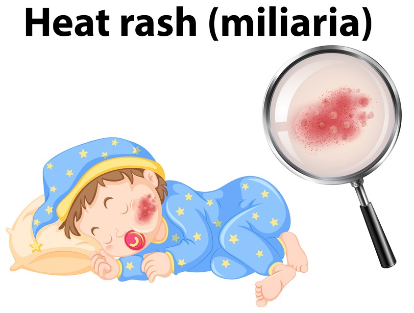 Các tuyến mồ hôi kém phát triển có thể gây phát ban nhiệt ở trẻ sơ sinh. Nguồn Freepik Các tuyến mồ hôi kém phát triển có thể gây phát ban nhiệt ở trẻ sơ sinh. Nguồn Freepik