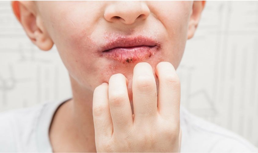 Dấu hiệu môi bị viêm lỡ