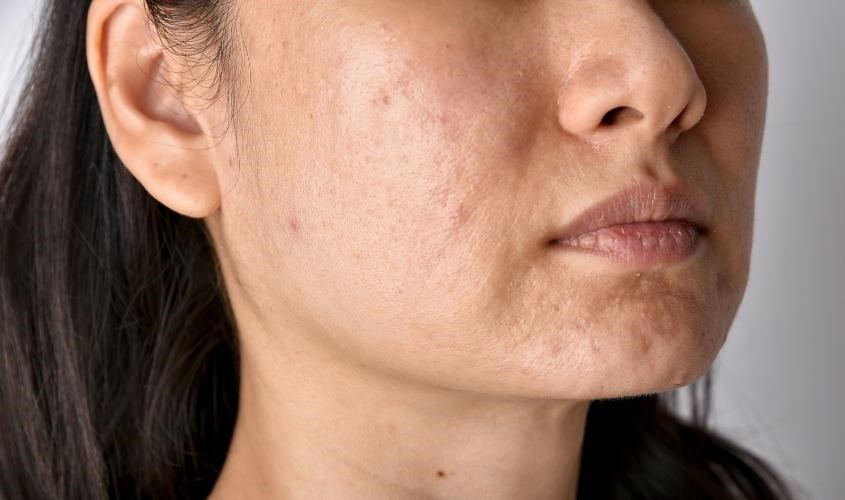 Mụn ẩn khiến da khô và sần sùi