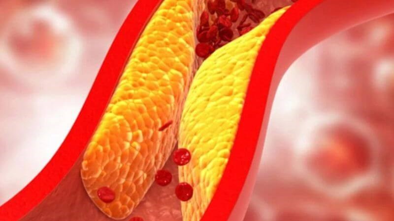 Người bệnh xơ vữa động mạch thường dễ bị đột quỵ khi ngủ