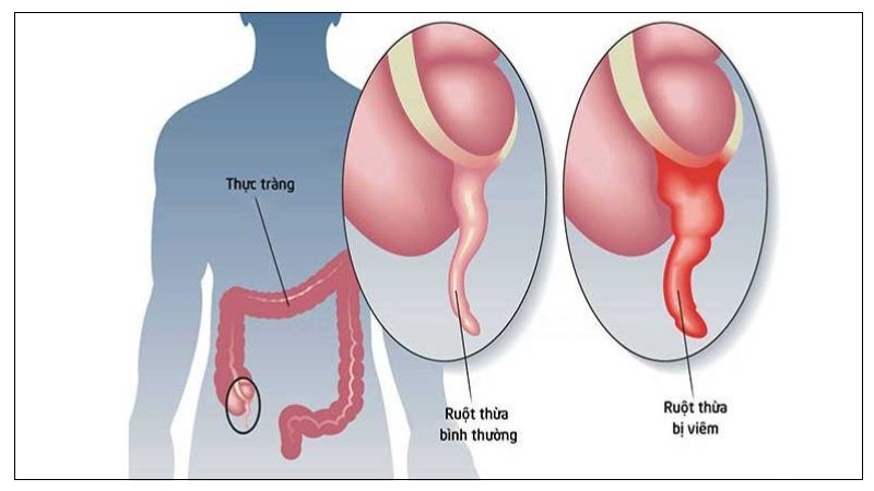 Viêm ruột thừa cấp là tình trạng nhiễm trùng ruột thừa Viêm ruột thừa cấp là tình trạng nhiễm trùng ruột thừa