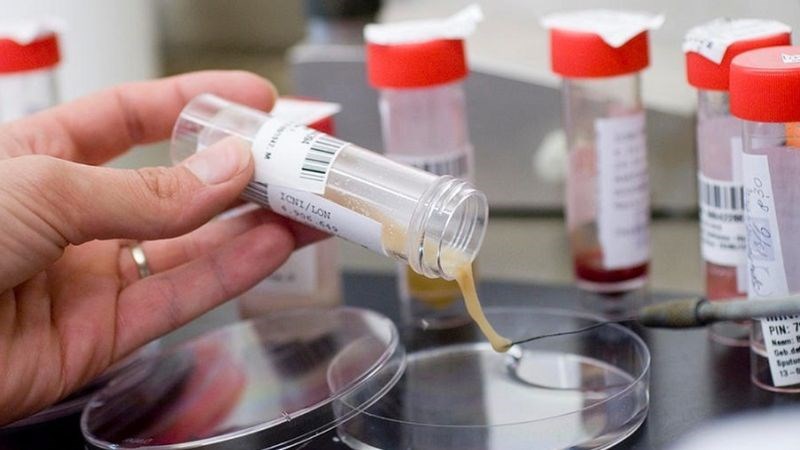 Xét nghiệm soi đờm tìm vi khuẩn lao là xét nghiệm phổ biến nhất để chẩn đoán bệnh.