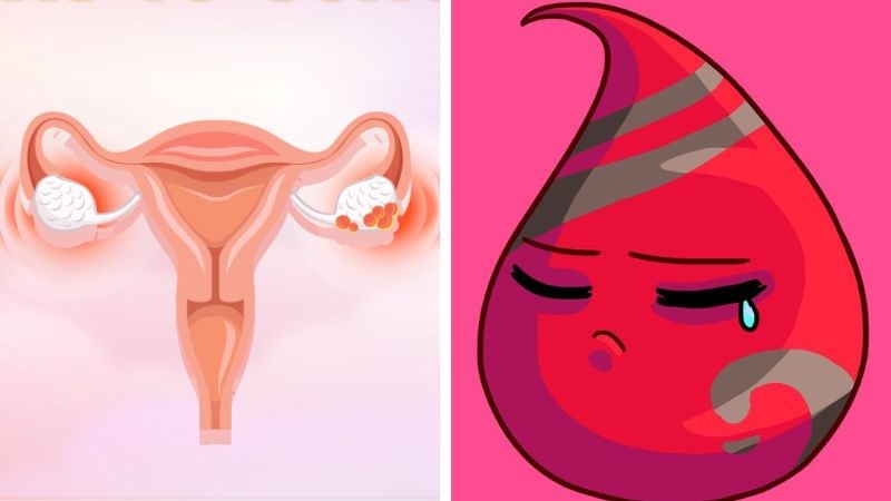 Máu kinh nguyệt màu xám đỏ lẫn lộn có thể là do u xơ tử cung. Máu kinh nguyệt màu xám đỏ lẫn lộn có thể là do u xơ tử cung.