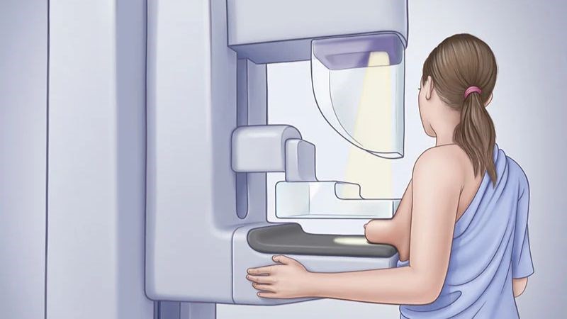 Chụp X-quang tuyến vú (Mammography) là phương pháp mang lại hiệu quả cao trong sàng lọc và chẩn đoán ung thư vú