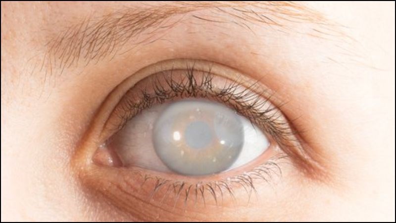 Béo phì có thể dẫn đến đái tháo đường type 2 với hậu quả là tổn thương mắt Béo phì có thể dẫn đến đái tháo đường type 2 với biến chứng là tổn thương mắt