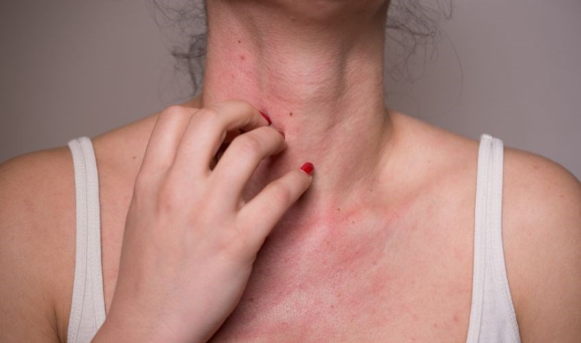 Nếu bạn dễ bị dị ứng, hãy cân nhắc khi dùng mật ong Nếu bạn dễ bị dị ứng, hãy cân nhắc khi dùng mật ong