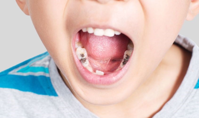 Tình trạng thiếu Fluor gây ra nhiều bệnh lý sâu răng cho cơ thể