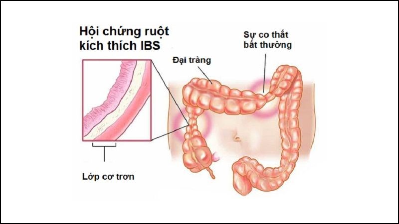 Người bị hội chứng ruột kích thích không nên ăn nhiều kim chi