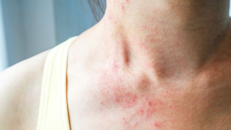Sữa chua cung cấp các chất có lợi cho cơ thể, làm giảm các phản ứng dị ứng