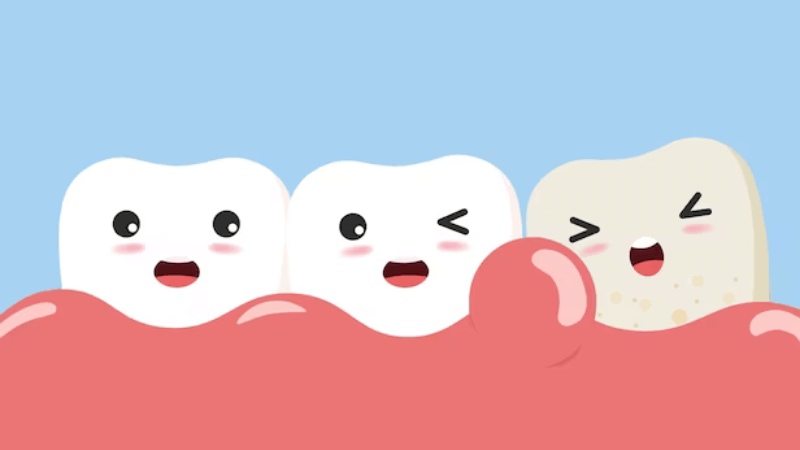 Khối mủ tại nướu, đau răng có thể là dấu hiệu của áp xe nướu (lợi)