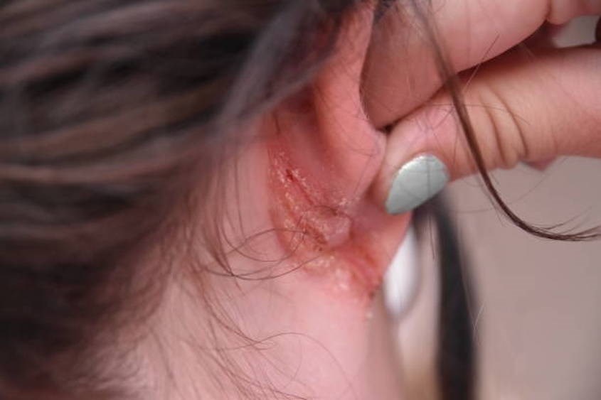 Nếu tai trẻ bị đỏ nhiều tuần thì có thể tai đã bị nhiễm trùng - Nguồn: istockphoto