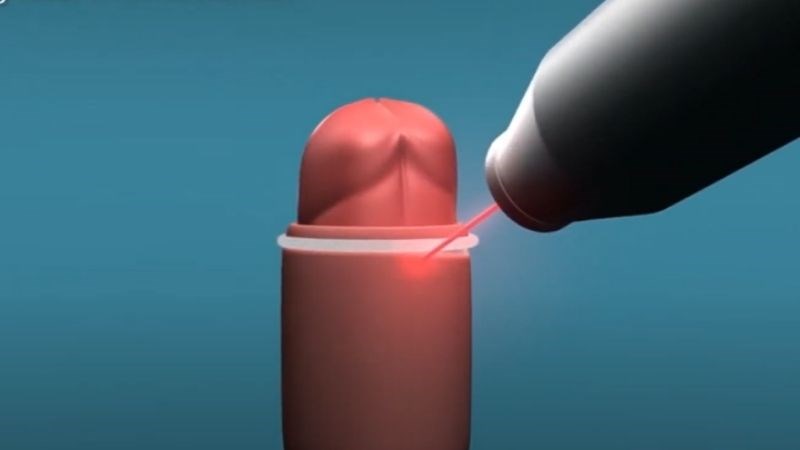 Cắt bao quy đầu dài bằng tia laser giúp làm giảm nguy cơ nhiễm trùng Cắt bao quy đầu dài bằng tia laser giúp làm giảm nguy cơ nhiễm trùng