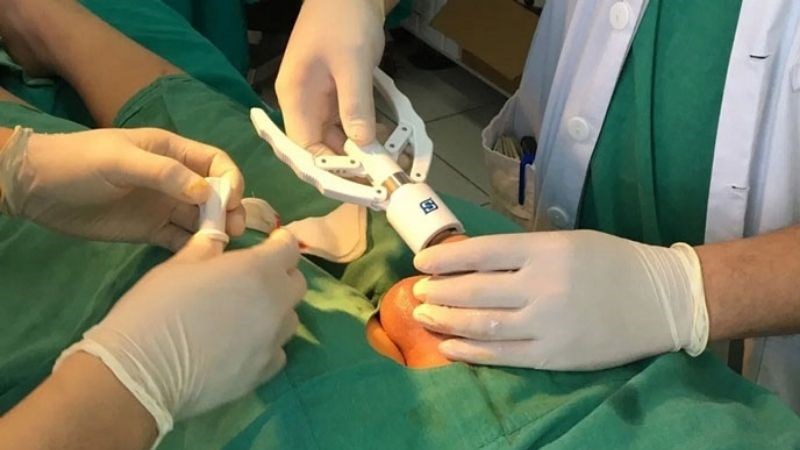 Kỹ thuật xâm lấn tối thiểu để cắt bao quy đầu là phương pháp hiện đại nhất Kỹ thuật xâm lấn tối thiểu để cắt bao quy đầu là phương pháp hiện đại nhất