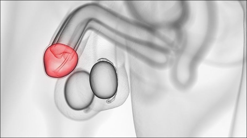 Viêm bao quy đầu gây sưng, đỏ, đau và mùi hôi khó chịu Viêm bao quy đầu gây sưng, đỏ, đau và mùi hôi khó chịu